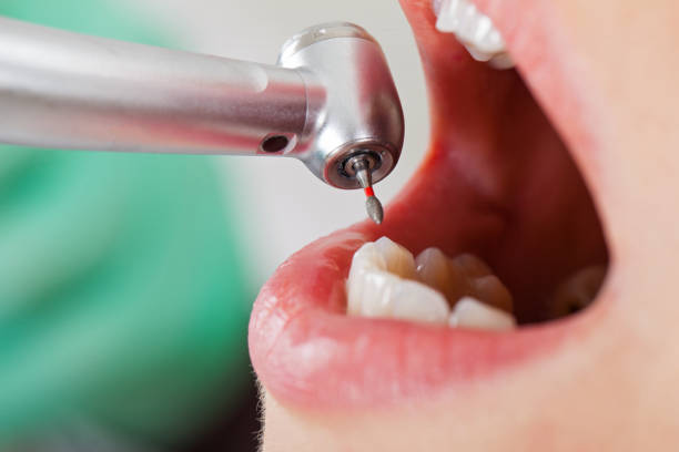 Best Broken or Cracked Tooth Emergency Dentist in Aho Falls, ID